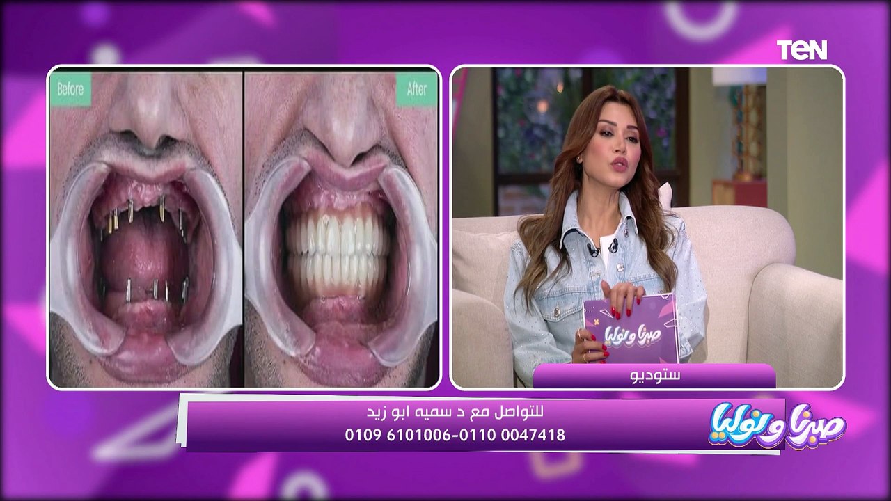 د. سمية صبحي استشاري زراعة الأسنان تتحدث عن أنواع زراعة الأسنان والحالات التي يجب التدخل بها