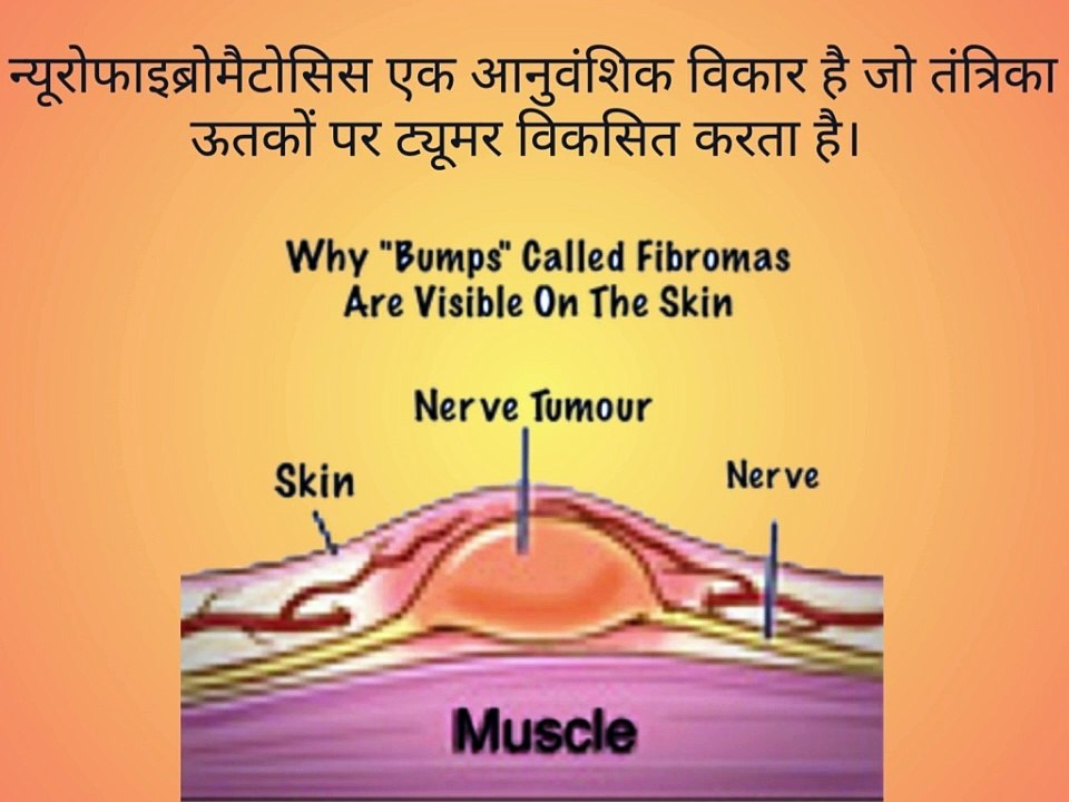 Neurofibromatosis, नसों में फोड़े, न्यूरोफाइब्रोमैटोसिस के लक्षण