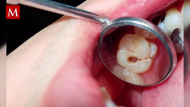 ¿Es algo malo? Este es el significado de soñar que se te caen los dientes