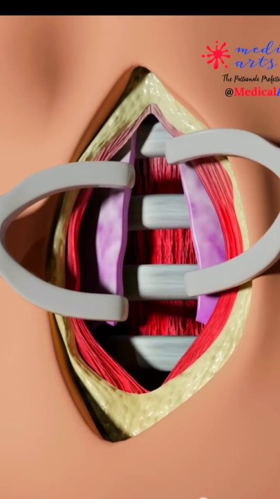 Tracheostomy procedure 3D animation_Tracheostomy_ Tubeट्रेकियोस्टोमी ट्यूब_#viral#shorts#shortsfeeds