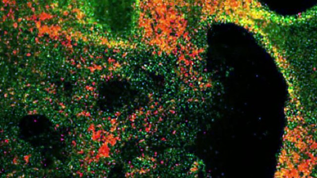 Padova realizzer? modelli statistici sui tumori al polmone