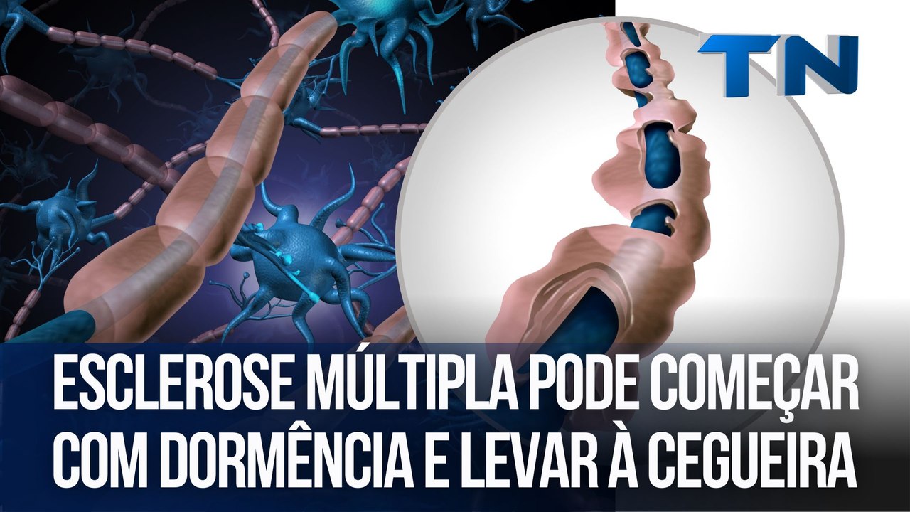 Esclerose múltipla pode começar com dormência e levar à cegueira | Cuide-se Bem!