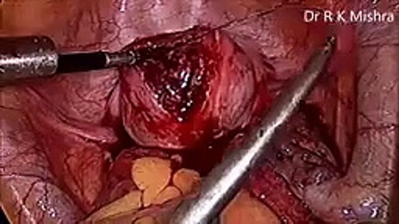 Laparoscopic Myomectomy by Dr R K Mishra