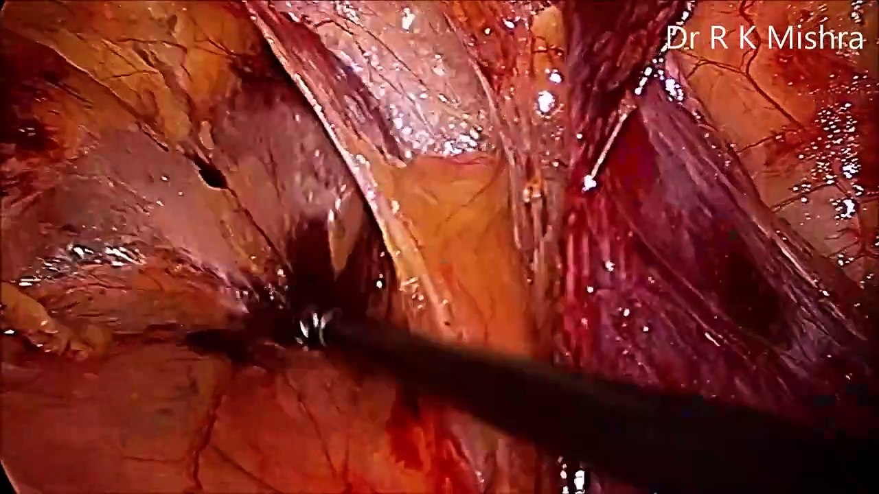 Bilateral TAPP Inguinal Hernia Surgery
