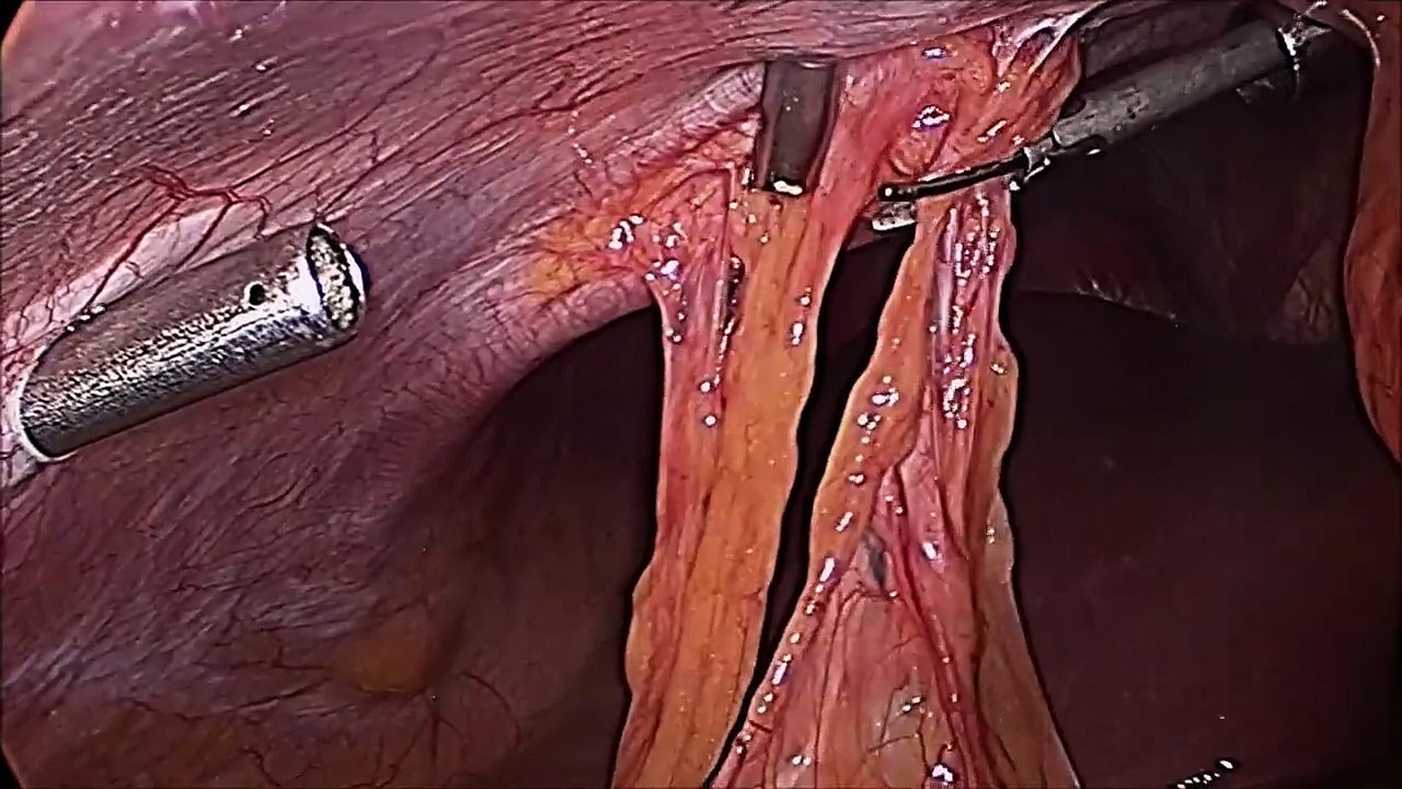 Cholecystectomy