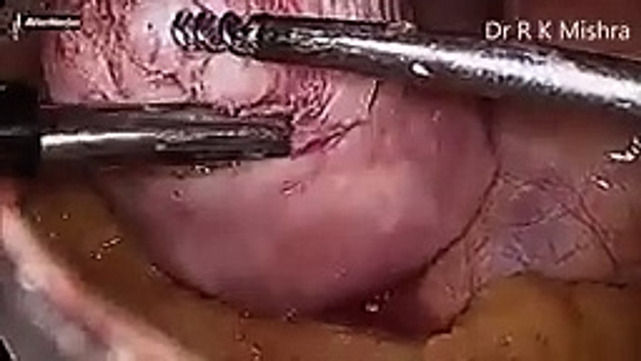 Laparoscopic Management of Intramural Fibroid