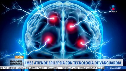 IMSS atiende a pacientes con epilepsia con tecnología de vanguardia