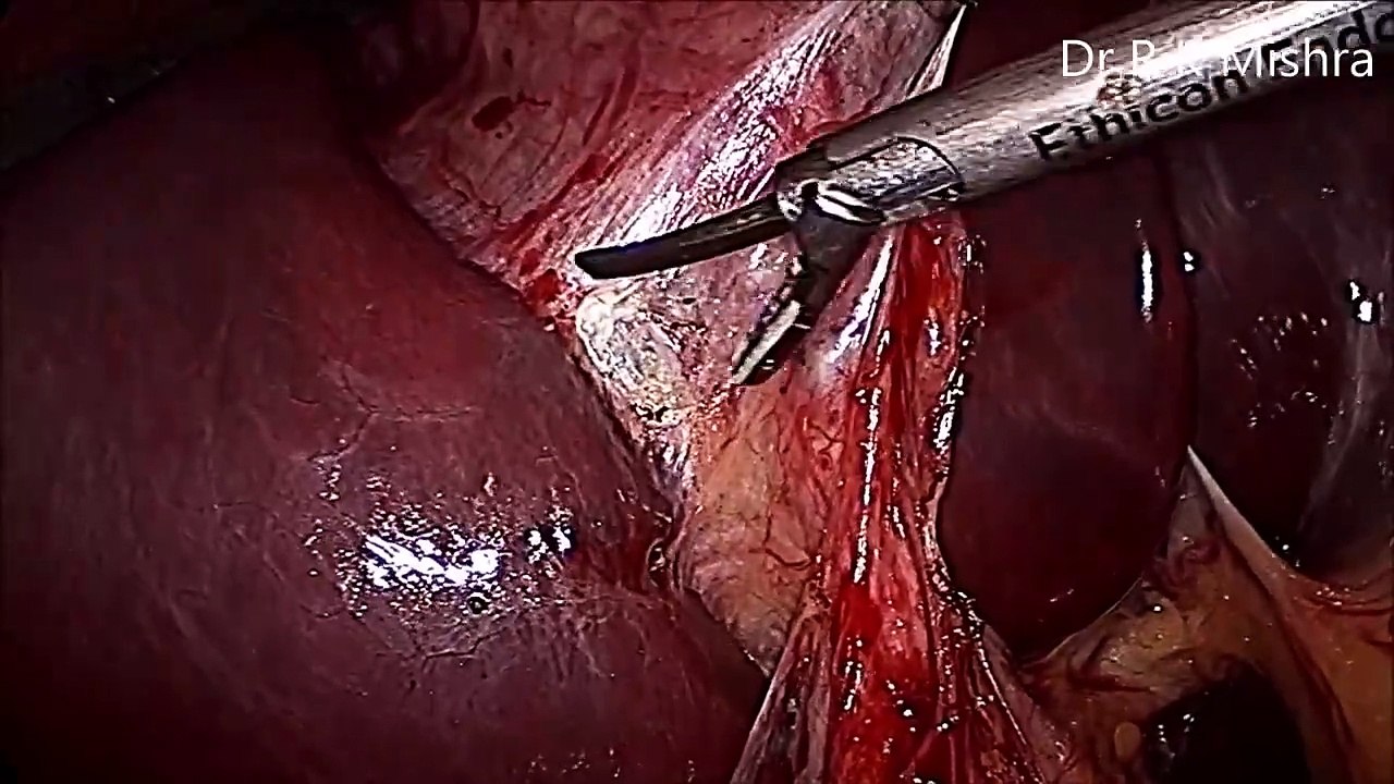 Cholecystectomy and Appendectomy together by Mishra's knot