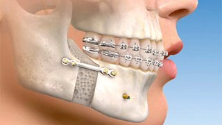 Entenda quais os benefícios e indicações da cirurgia ortognática com o ortodontista Felipe Vieira