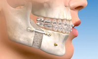 Entenda quais os benefícios e indicações da cirurgia ortognática com o ortodontista Felipe Vieira