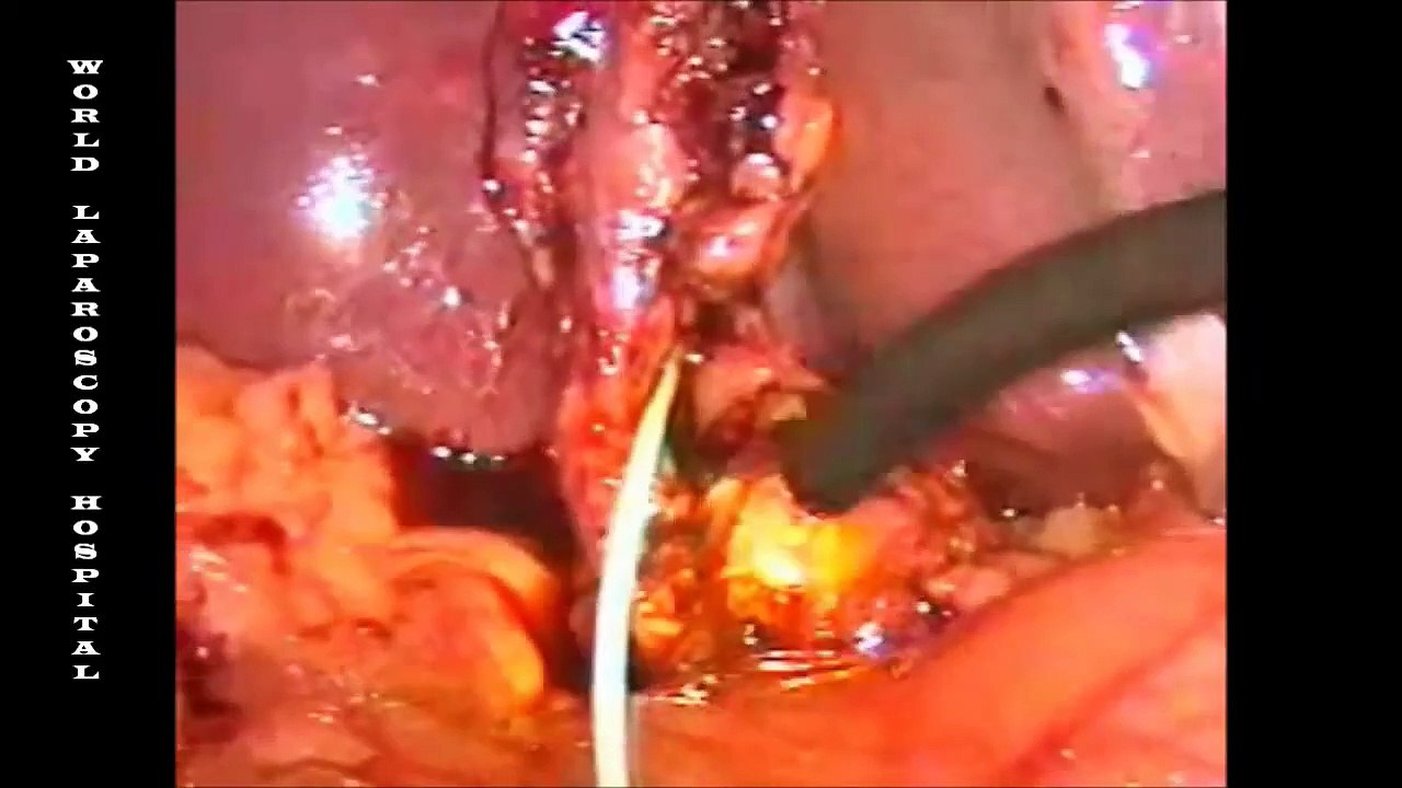 Choledocoscopy at World Laparoscopy Hospital