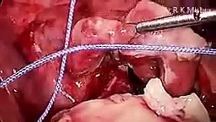 Laparoscopic Management of Rupture Pediatric Appendix in Pediatric Patient
