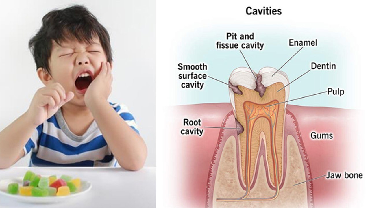 Deciduos Teeth Infection के बाद इलाज क्यों करान...