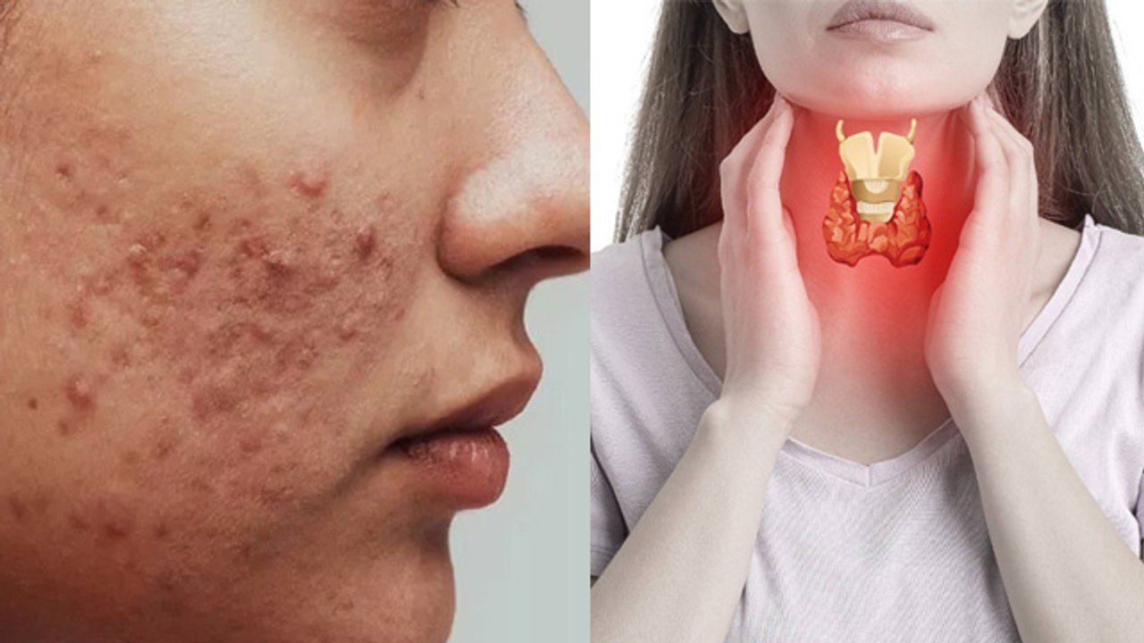 Thyroid Se Pimples Badhte Hai Kya Acne Due To Thyroid Reason In Hindi