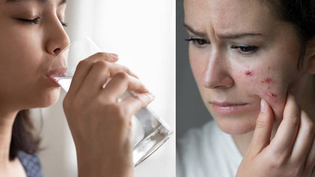 क्या ज्यादा पानी पीने से मुहासे दूर हो सकते हैं | Does Drinking Water Help With Acne | Boldsky