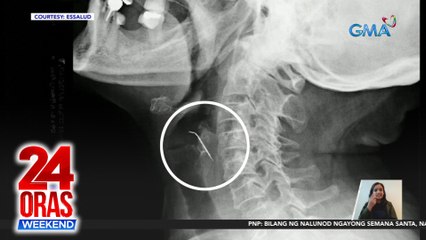 Ginang sa Peru, naospital matapos makalunok ng pako habang kumakain ng chicharon | 24 Oras Weekend