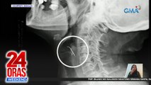 Ginang sa Peru, naospital matapos makalunok ng pako habang kumakain ng chicharon | 24 Oras Weekend