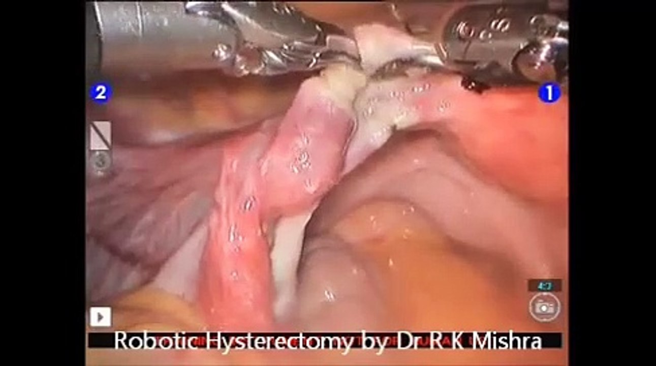 da Vinci Hysterectomy Surgery by Dr R K Mishra