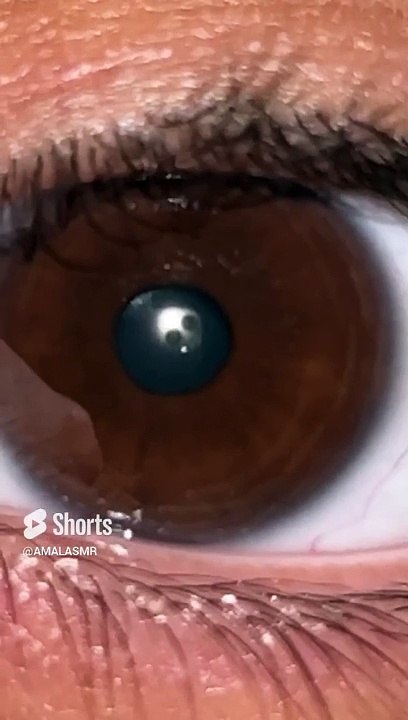 Eye