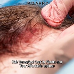 Hair Transplant Cost in Florida and Your Affordable Options