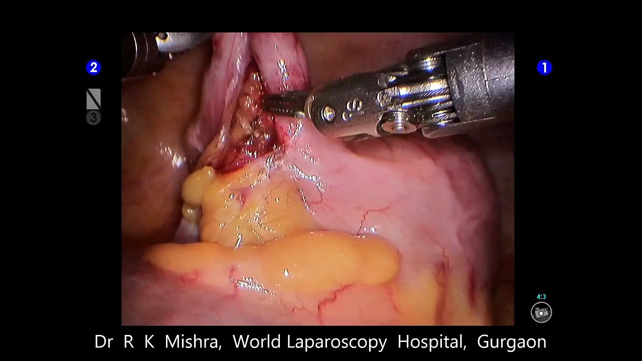 da Vinci Robotic Appendicectomy by Dr R K Mishra