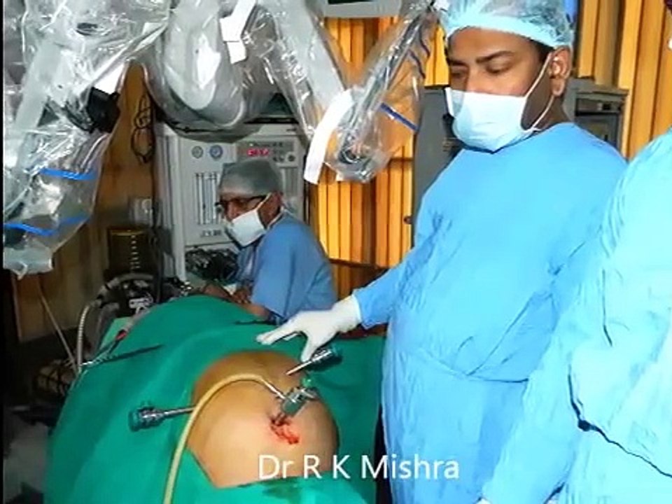 da Vinci Robotic Cholecystectomy by Dr R K Mishra in a patient with liver cirrhosis