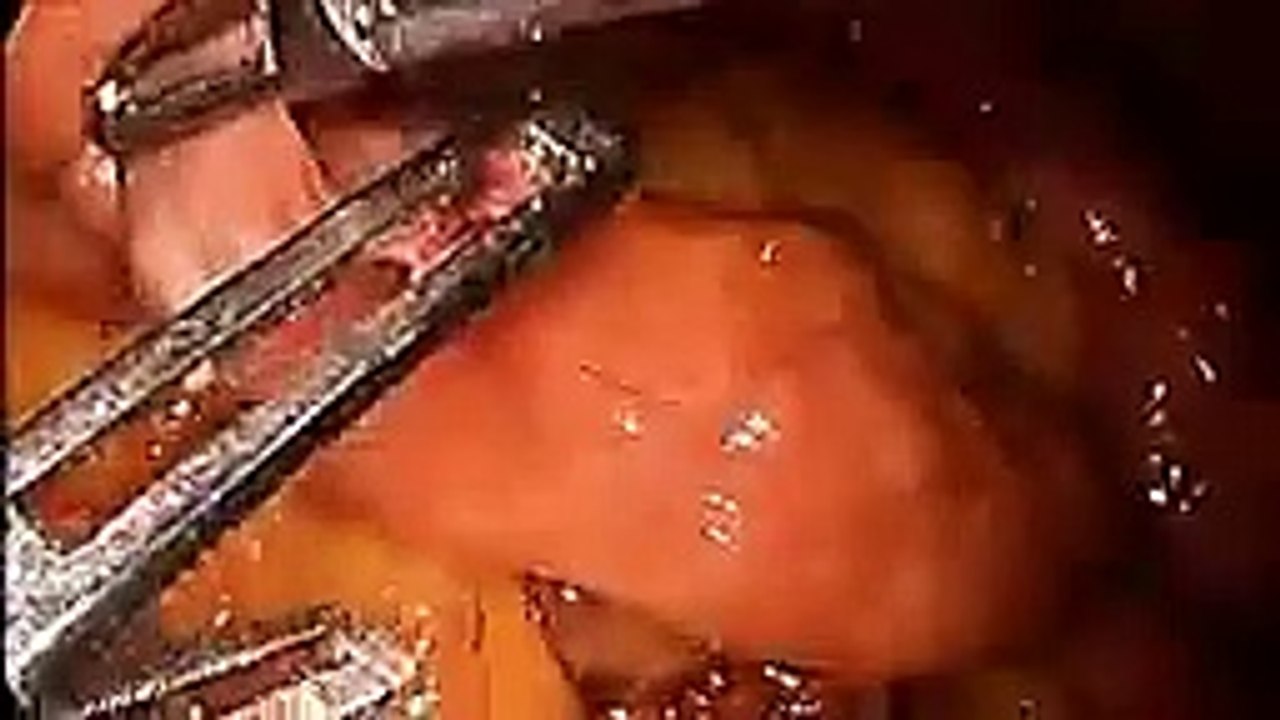 MGB - An Effective Bariatric Surgery