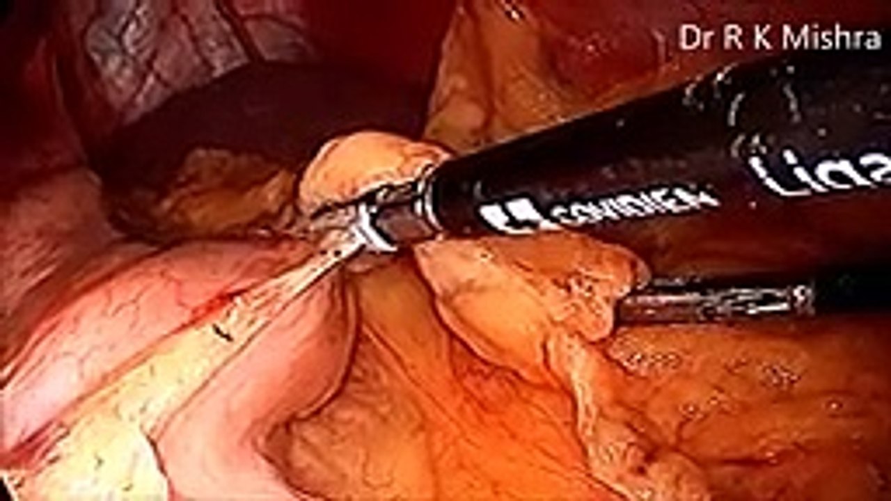 Sleeve Gastrectomy Fully Explained by Dr R K Mishra