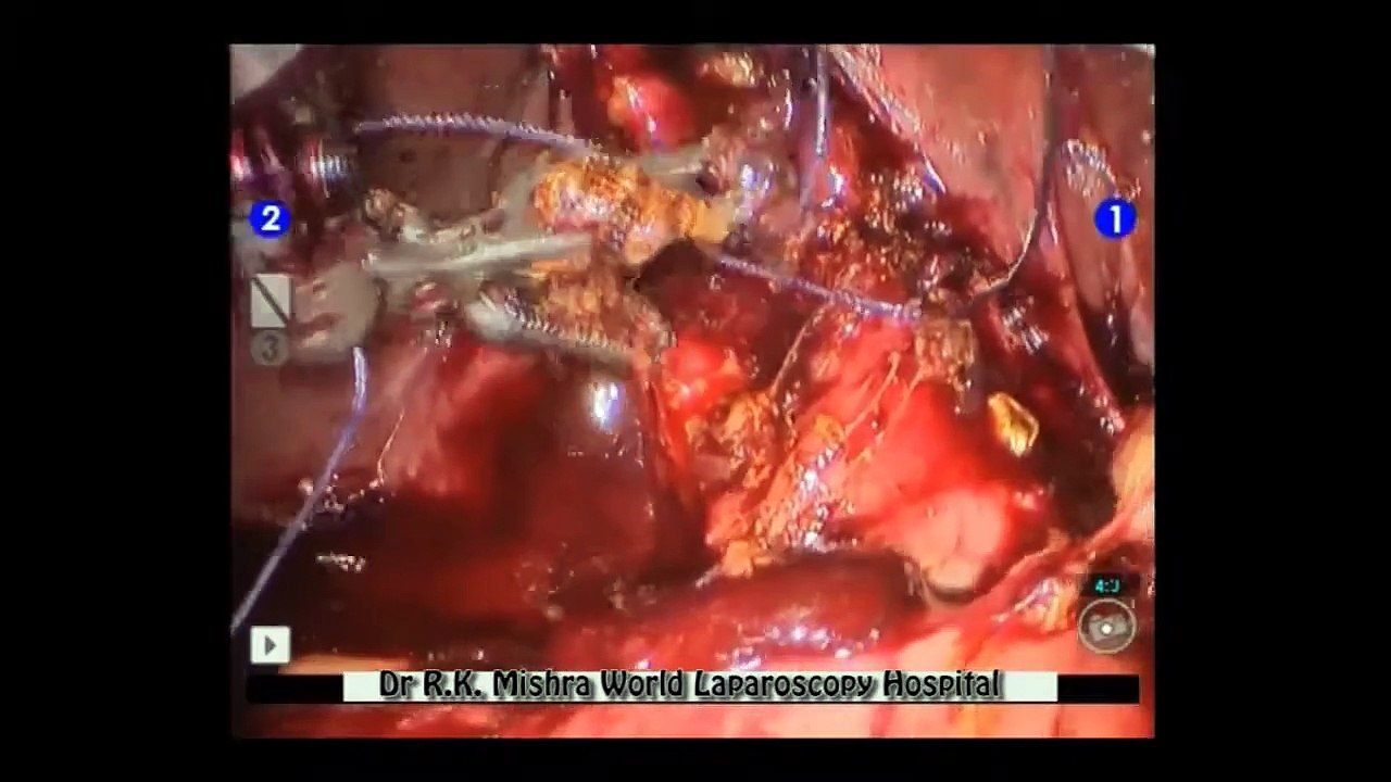 da Vinci Robotic Cholecystectomy for Mirizzi's syndrome by Dr R K Mishra