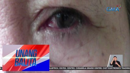 Sore eyes, karaniwang sakit ngayong tag-init | UB