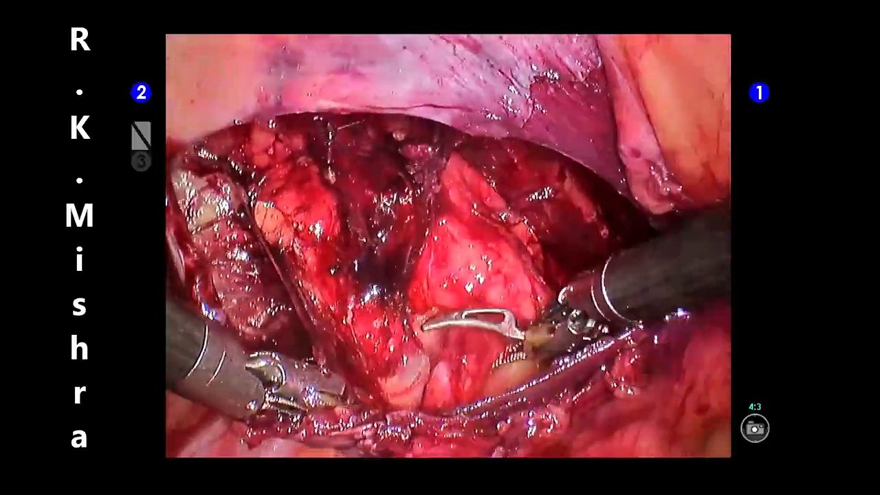 da Vinci Robotic Inguinal Hernia Surgery by Dr. R.K. Mishra
