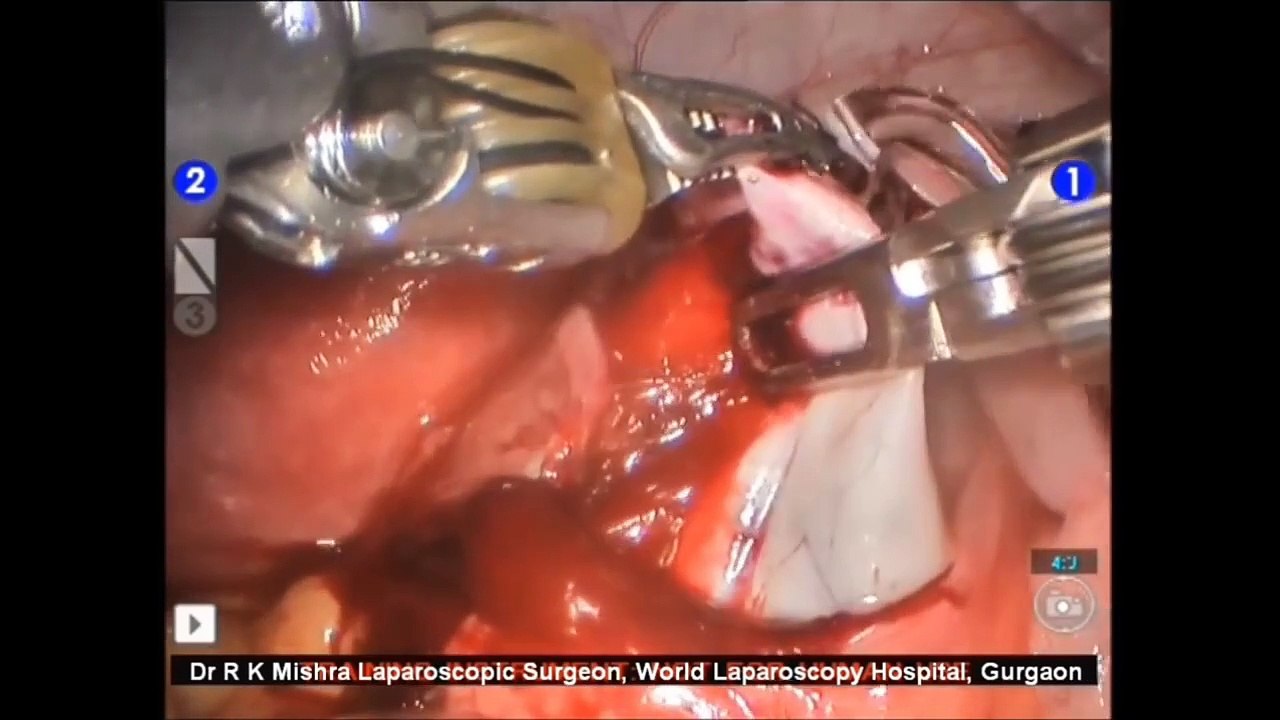 da Vinci Robotic Ovarian Cystectomy by Dr R K Mishra