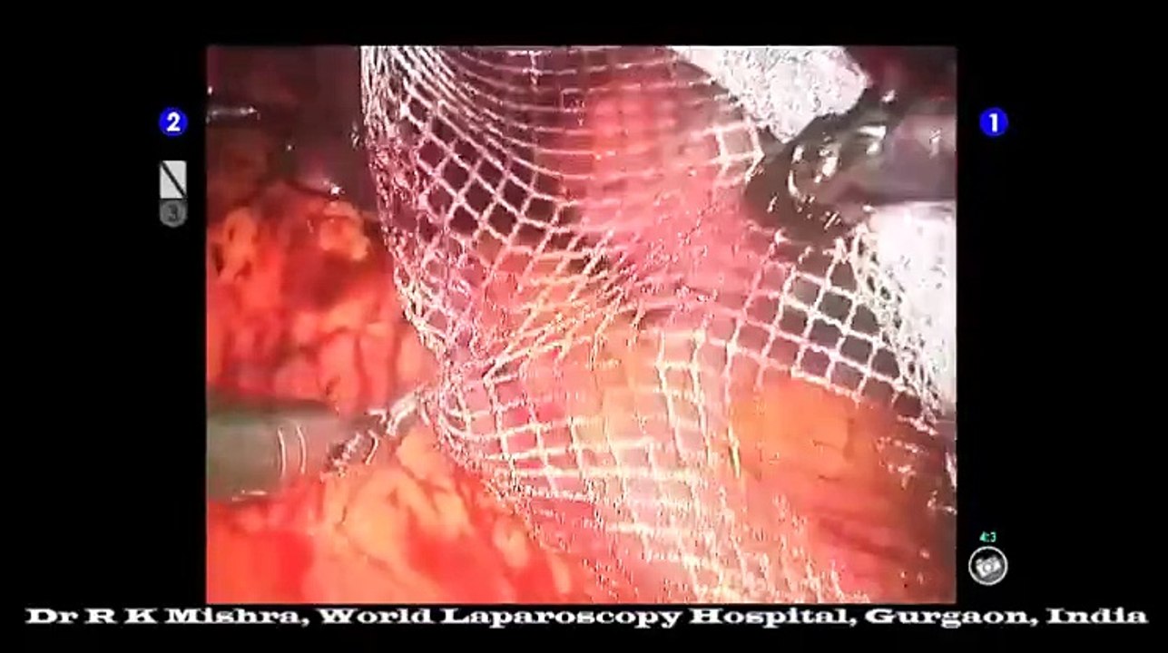 da vinci robotic repair of bilateral direct recurrent inguinal hernia