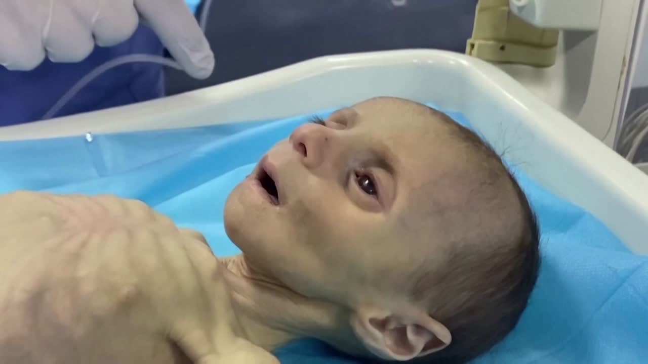 Niños desnutricion