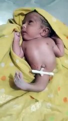 A baby is born with one leg but no anus or urine