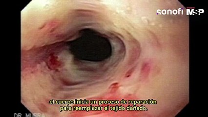 Conexión entre la esofagitis y estenosis esofágica - #ExclusivoMSP