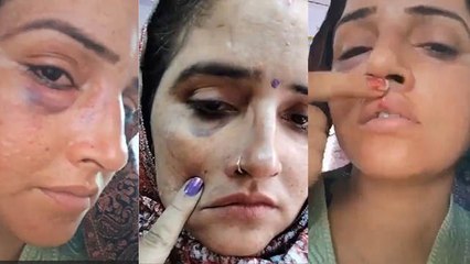 Seema Haider Swollen Face Injury Video पर Shocking Reaction Viral, Sachin Torture Truth Reveal