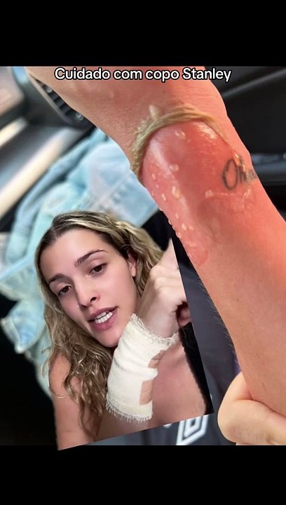 Jovem coa café em copo Stanley e tem queimaduras de 2º grau