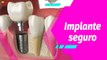 Buena Vibra | Implantes dentales: Todo lo que necesitas saber