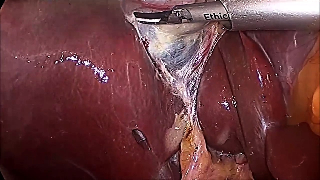 Dangerous way of Performing Laparoscopic Cholecystectomy