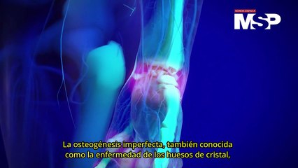 Huesos de cristal: ¿Qué es la osteogénesis imperfecta y cómo actúa? - #ExclusivoMSP