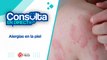 Alergias en la piel | Consulta en directo 9 abril 2024