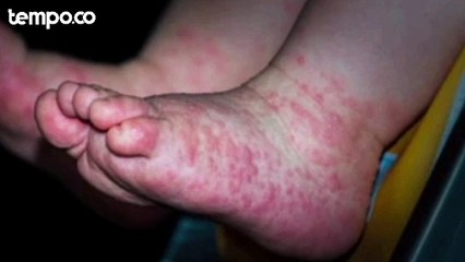 Kemenkes Wanti-wanti Penyakit HFMD dan Demam Berdarah di Libur Lebaran 2024