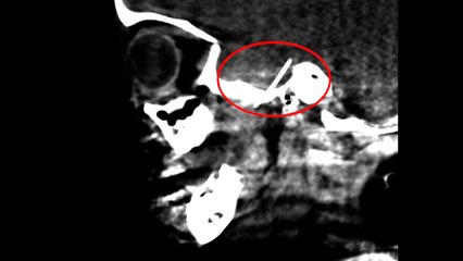 Salvan a una niña de 4 años que tenía una aguja de dentista alojada en el cerebro