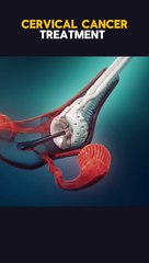 Cervical Cancer Treatment 3D Animation