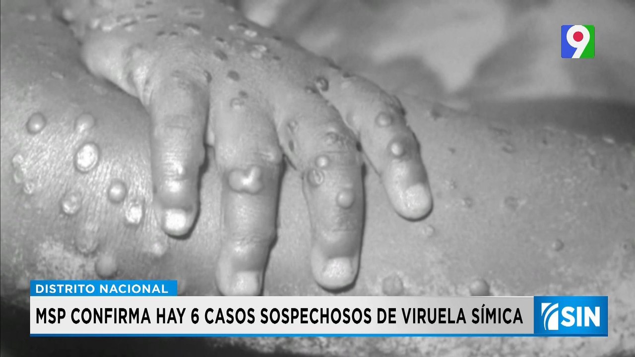 Investigan seis casos sospechosos de viruela símica| Primera Emisión SIN