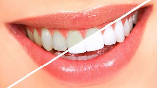 Ortodontista explica quais são os principais benefícios do clareamento dental
