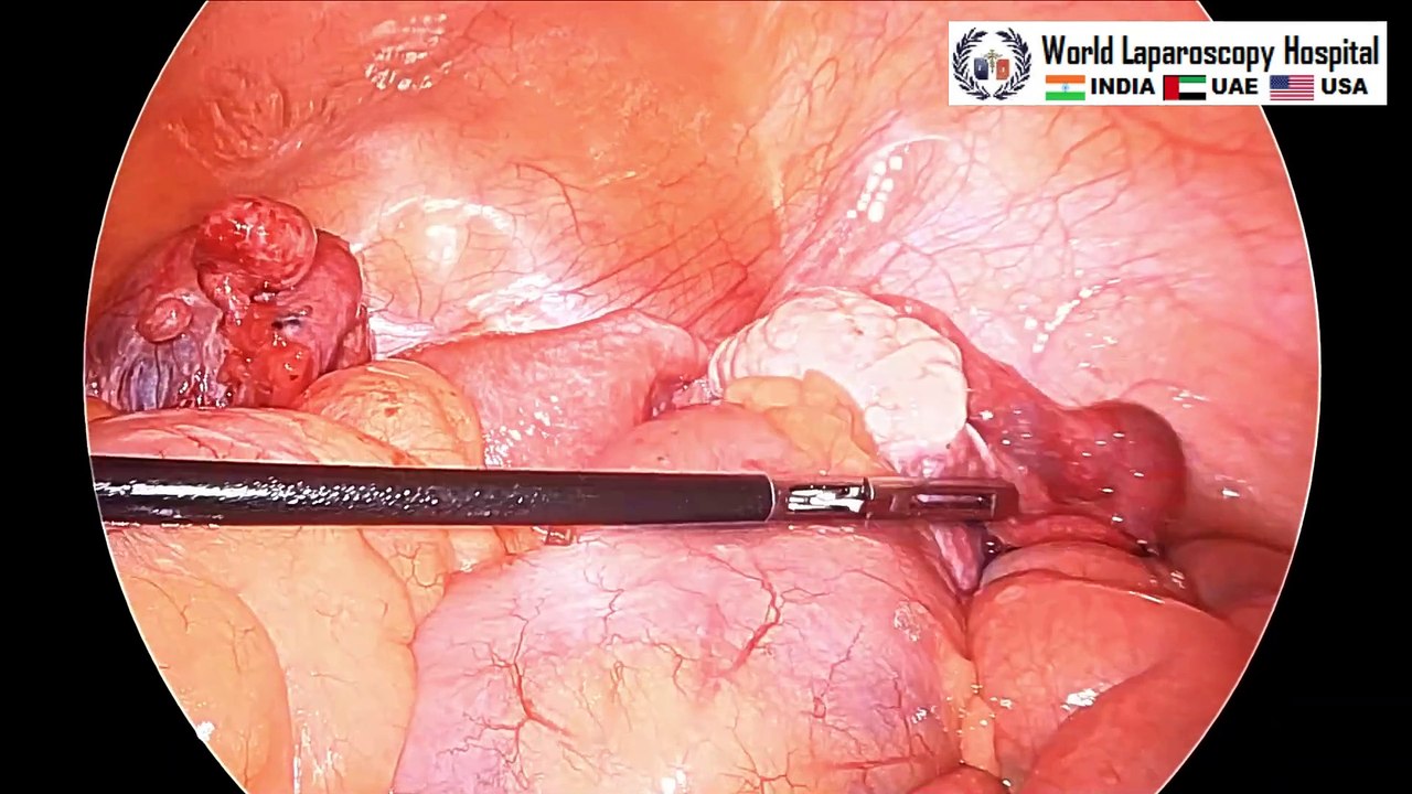 Diagnostic Hysteroscopy, Tubal Patency Test and Paraovarian Cystectomy