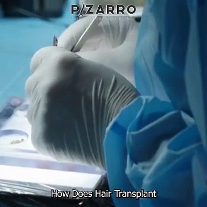 How Does Hair Transplant Hold Up After 10 Years?