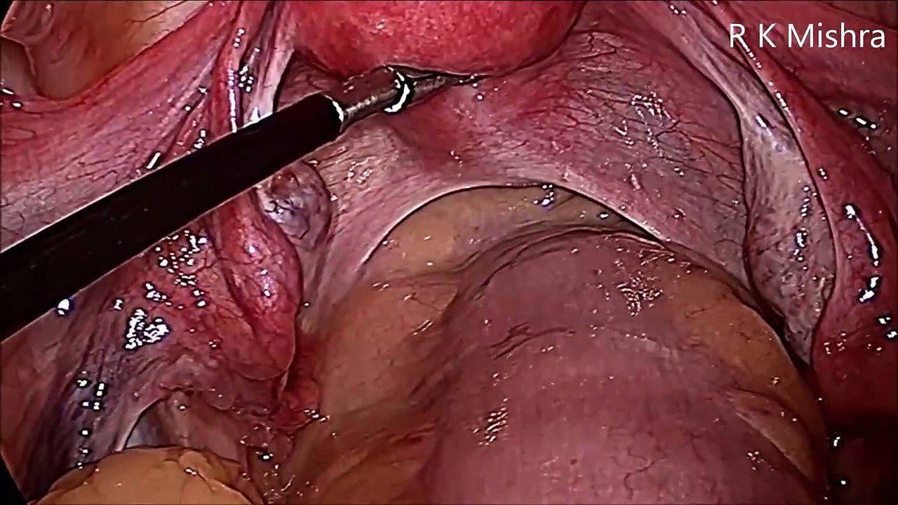 Diagnostic Laparoscopy and Tubal Patency Test